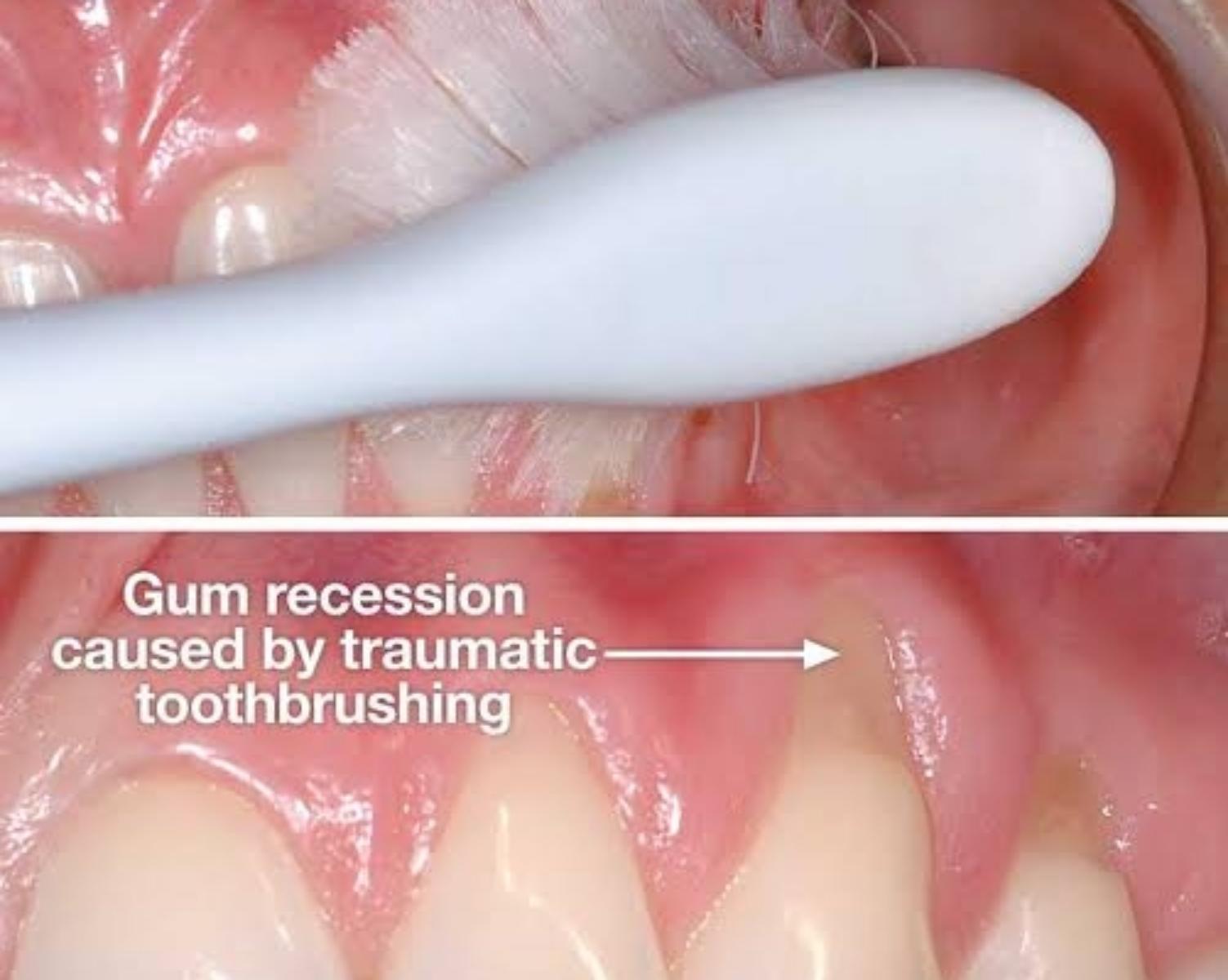 Myth 3: Brushing Harder Cleans Better