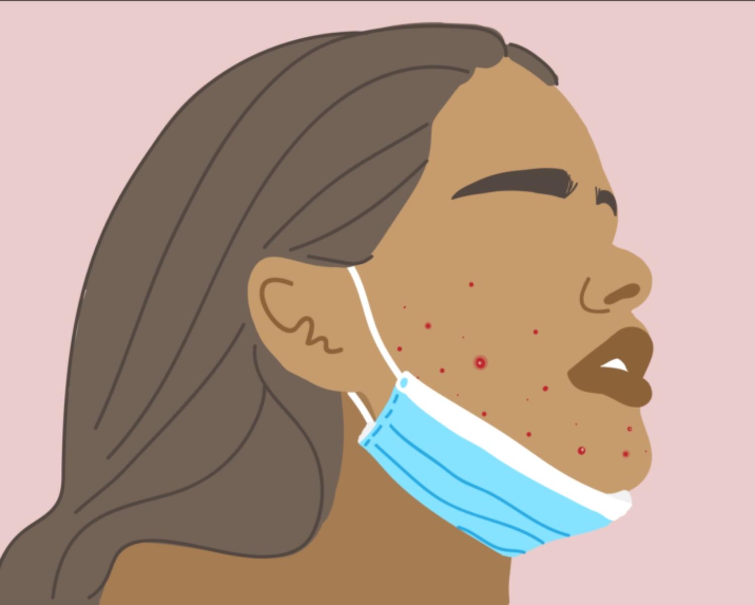 Should you dry out maskne or keep it moisturized