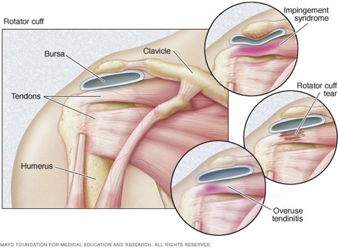 Rotator Cuff Injury : Overview 