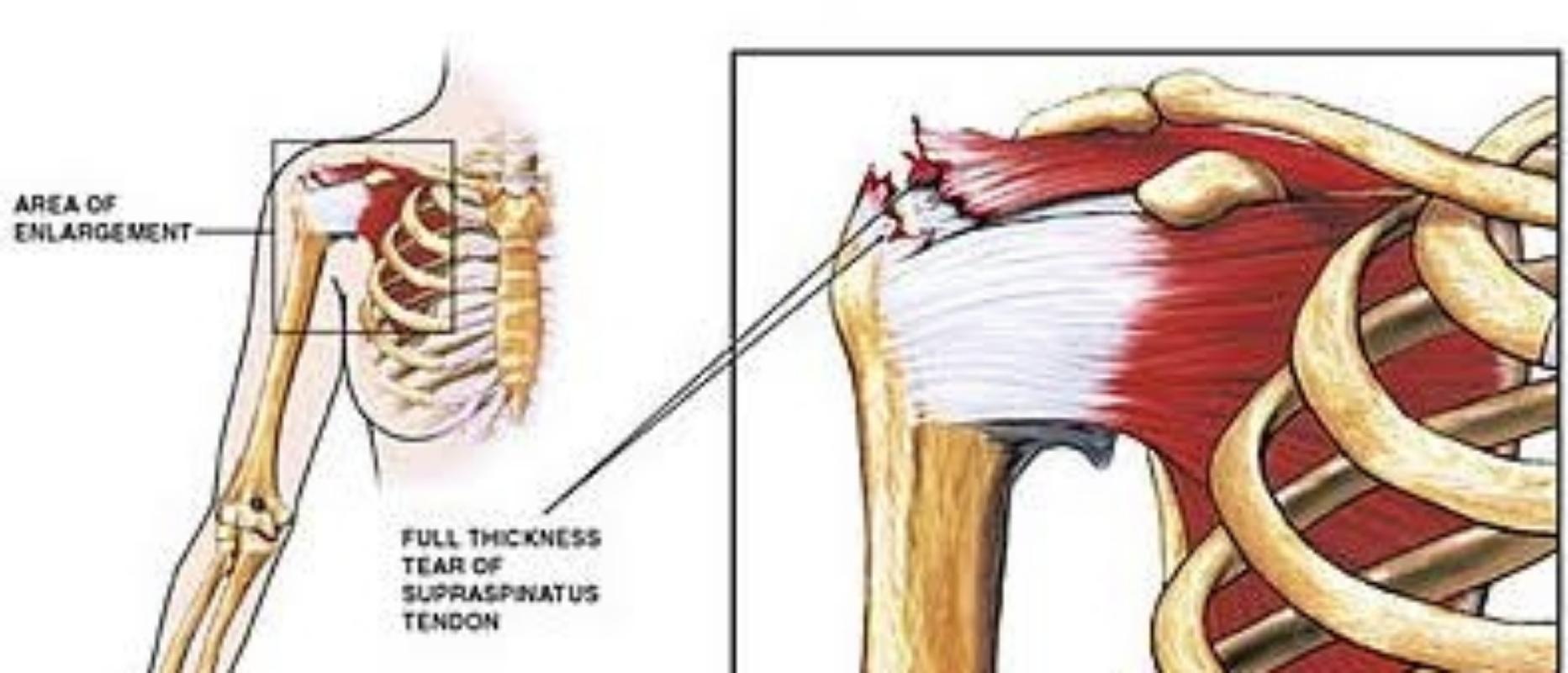 Rotator Cuff Injury : Ms Tear